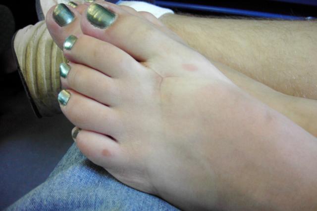 This is the result of wearing your flipflops too long!